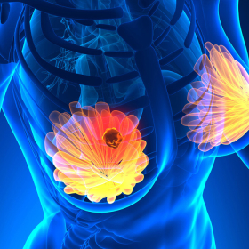 Phẫu thuật vú xâm lấn tối thiểu (MIS) phát hiện sớm và điều trị các bất thường