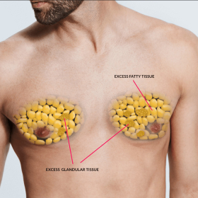 Phì đại tuyến vú ở nam giới: Nguyên nhân, tiên lượng và cách điều trị