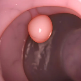 Polyp cổ tử cung có gây ung thư không​? Phương pháp điều trị bệnh như nào?