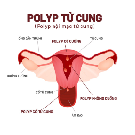 Polyp tử cung là gì? Nguyên nhân, biến chứng và phòng ngừa