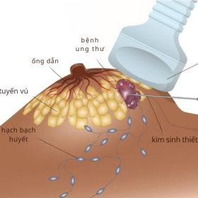 Sinh thiết vú: Chỉ định, quy trình, ưu điểm và nhược điểm