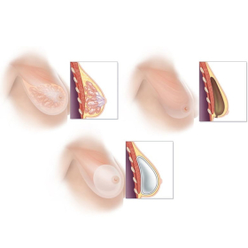  Tái tạo vú bằng túi ngực là gì? Chỉ định và quy trình thực hiện tái tạo vú