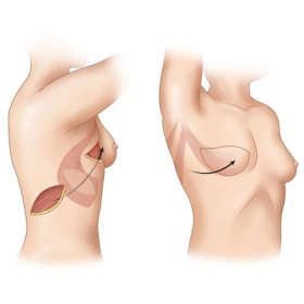 Tái tạo vú sau điều trị ung thư: Quy trình, biến chứng và cách tái tạo