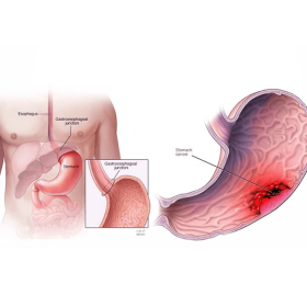 Tổng quan về ung thư dạ dày: Những điều bạn cần biết