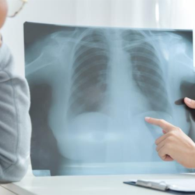 Tràn dịch màng phổi có chữa được không? Biến chứng và cách phòng ngừa