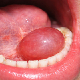 U nang dưới lưỡi: triệu chứng thường gặp và hướng xử trí