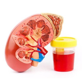 U nguyên bào thận là gì? Các giai đoạn, dấu hiệu và cách điều trị