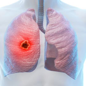 U phổi là gì? Phân biệt, triệu chứng, chẩn đoán và điều trị