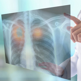 U phổi lành tính là gì? Nguyên nhân, phân biệt và hướng điều trị