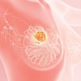 U vú lành tính có nên mổ không? Chỉ định, rủi ro và khi nào phẩu thuật