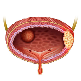 Ung thư bàng quang là gì? Nguyên nhân, dấu hiệu và cách điều trị