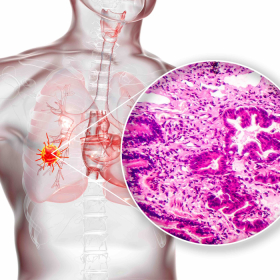 Ung thư biểu mô tuyến phổi: Nguyên nhân, triệu chứng và cách điều trị