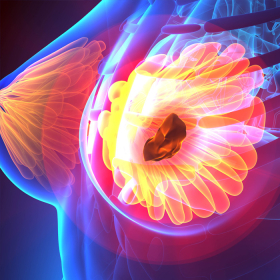 Ung thư biểu mô tuyến vú: Thông tin tổng quan cần biết