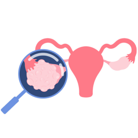 Ung thư buồng trứng là gì? Nguyên nhân, dấu hiệu và cách điều trị