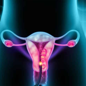 Ung thư cổ tử cung di căn hạch: Nguyên nhân, dấu hiệu và lưu ý khi điều trị