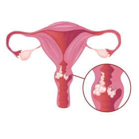 Ung thư cổ tử cung: Nguyên nhân, triệu chứng và cách phòng bệnh