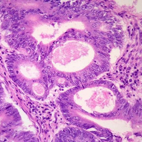 Ung thư da carcinoma tế bào gai: Nguyên nhân và cách phòng ngừa