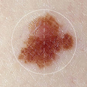 Mắc bệnh ung thư da giai đoạn đầu có chữa được không? 