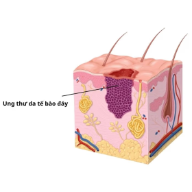 Ung thư da tế bào đáy: Nguyên nhân, dấu hiệu cảnh báo và điều trị