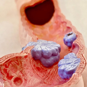 Ung thư đại tràng là gì? Nguyên nhân và dấu hiệu nhận biết sớm