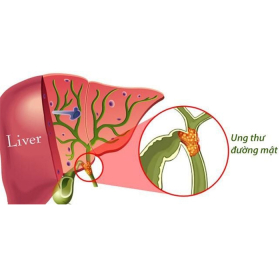 Ung thư đường mật: Nguyên nhân, triệu chứng và cách điều trị
