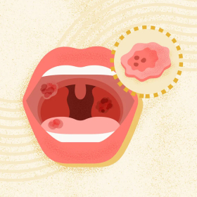 Ung thư hầu họng: Dấu hiệu sớm, chẩn đoán và hướng điều trị mới nhất