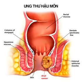 Ung thư hậu môn là gì? Nguyên nhân, dấu hiệu và cách điều trị