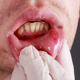 Ung thư khoang miệng sống được bao lâu? Tiên lượng sống hiện nay