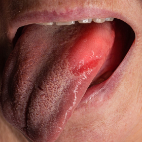 Ung thư lưỡi giai đoạn cuối: Triệu chứng, điều trị và tiên lượng