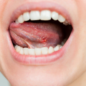 Ung thư lưỡi giai đoạn cuối có nguy hiểm không, còn điều trị được không?