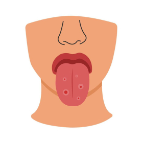 Ung thư lưỡi giai đoạn đầu: Dấu hiệu và cách điều trị hiệu quả