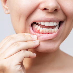 Ung thư lưỡi sống được bao lâu? Tỷ lệ sống của bệnh