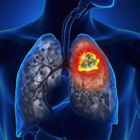 Ung thư màng phổi: Nguyên nhân, đối tượng, chẩn đoán và phòng ngừa