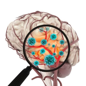 Ung thư não cấp độ 4: Tiên lượng, triệu chứng và điều trị