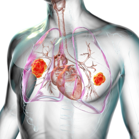 Ung thư phổi có chữa được không? Các giải pháp điều trị ung thư phổi