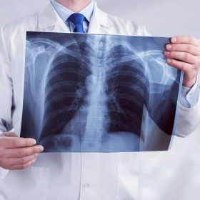 Ung thư phổi có di truyền không? Tìm hiểu ngay trước khi quá muộn