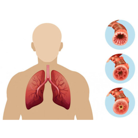 Ung thư phổi có lây không ? Cách phòng bệnh đúng cách