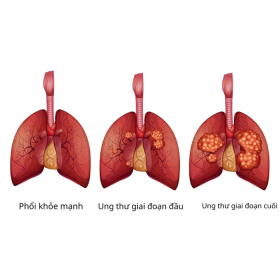 Ung thư phổi có mấy giai đoạn​? Chẩn đoán các giai đoạn theo hệ thống TNM