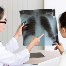 Ung thư phổi di căn có chữa được không? Phương pháp hỗ trợ điều trị hiện nay