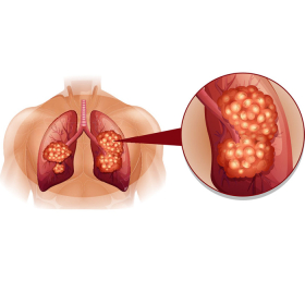 Ung thư phổi di căn màng phổi: Giai đoạn, triệu chứng và điều trị