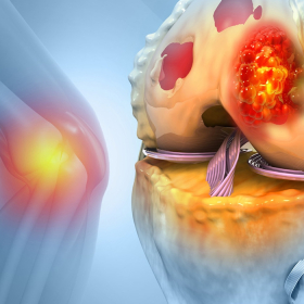 Ung thư phổi di căn​ xương: Quá trình, triệu chứng và điều trị