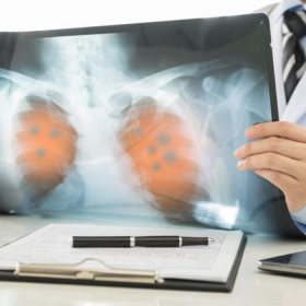 Ung thư phổi di căn xương sống được bao lâu? Phương pháp điều trị