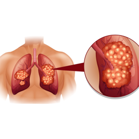 Ung thư phổi giai đoạn 1 sống được bao lâu​? Yếu tố ảnh hưởng tiên lượng sống