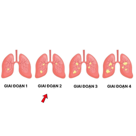 Ung thư phổi giai đoạn 2 là gì? Triệu chứng, tiên lượng và điều trị