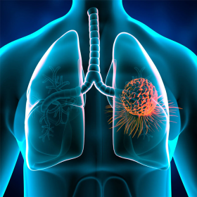 Ung thư phổi giai đoạn 2 có chữa được không? Cách làm chậm tiến triển bệnh