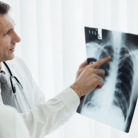 Người bị ung thư phổi giai đoạn 2 có nguy hiểm không?