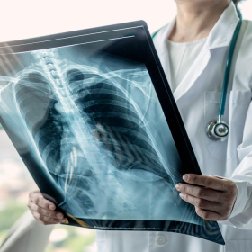 Ung thư phổi giai đoạn 3​: Triệu chứng, tiên lượng và mục tiêu điều trị