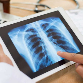 Ung thư phổi không tế bào nhỏ​: Nguyên nhân, mức độ nguy hiểm và chẩn đoán