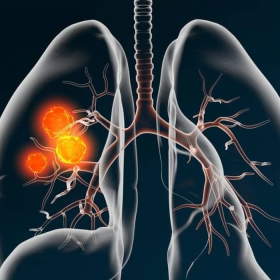 Ung thư phổi không tế bào nhỏ giai đoạn I: Tiên lượng sống và điều trị