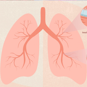 Ung thư phổi không tế bào nhỏ giai đoạn II: Triệu chứng và cách xử lý